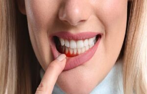 Gum Disease in San Juan