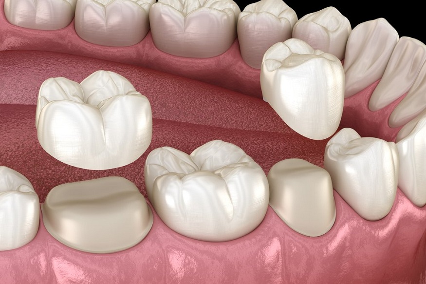 Dental Crowns